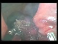 8373GS Novel Transanal Operation for Rectal Cancer Combining Ultrasonic Dissection, Titanium Knot...