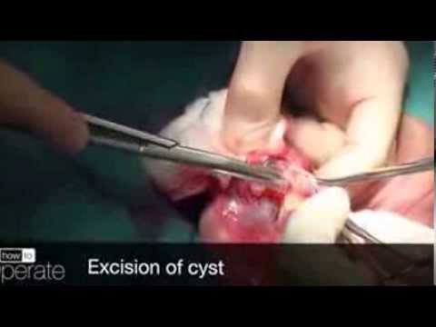 how to drain testicular cyst