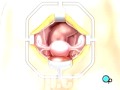 PreOp® Patient Education Hysterectomy Removal of Uterus, Ovaries and Fallopian Tubes Surgery* 3