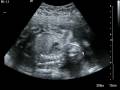 videos de JaNiyah Rose. 22 weeks Ultrasound