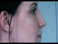 dr-steven-dayan-performs-rhinoplasty-computer-imaging.html