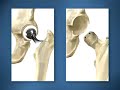 hip-replacement-nana.html