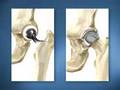 Birmingham Hip Resurfacing (BHR) Technique in Live Webcast