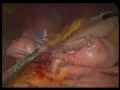 Cirug�a de Obesidad Ecuador, Bypass en Y de Roux