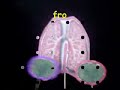 Intestinal Obstruction secondary to ascaris bolus