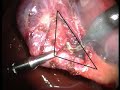 Triangulation in Surgery Triangulation in Surgery