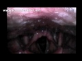 www.FauquierENT.net - Video of the voicebox while a person is singing, screaming, yodeling, and attempting to beat-box. Read more about this procedure here http Follow Us on Twitter www.twitter.com Like Us on Facebook www.facebook.com