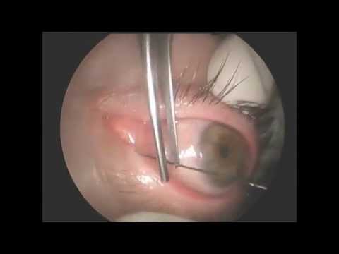 how to drain a blocked tear duct