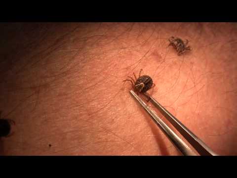 tick - Ticks attach to the skin with their mouthparts to draw blood. Once imbedded, their mouthparts are