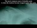 Rotator Cuff
