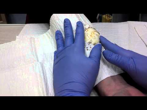 how to drain pus from boil