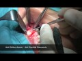 rialzo del seno mascellare - sinus lift