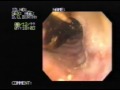 endoprothesis in the esophagus
