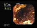 endoprothesis in the esophagus