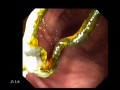 An unexpected guest in duodenum An unexpected guest in duodenum