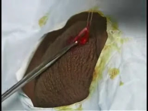 No-Scalpel Vasectomy - Part 1