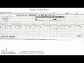 ECG Interpretation, Basic Level - Part 11 ECG Interpretation, Basic Level - Part 11
