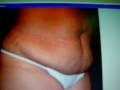 videos de cosmetic suregery,consultant cosmetic surgery,tummy tuck,liopsuction,breast surgery,plastic surgery,most famous,world wideو