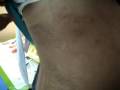 EMBARAZO, PREGNANCY- HERPES ZOSTER