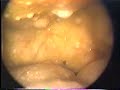 TUBERCULOSIS-PERITON