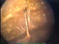 TUBERCULOSIS-PERITON