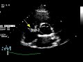 Tricuspid Valve Vegetation