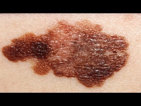 how to detect a skin cancer