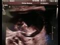 videos de Our babys heartbeat with an AngelSounds (baby week 15)