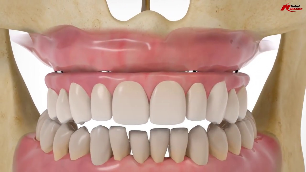 All on 4R treatment concept Nobel Biocare