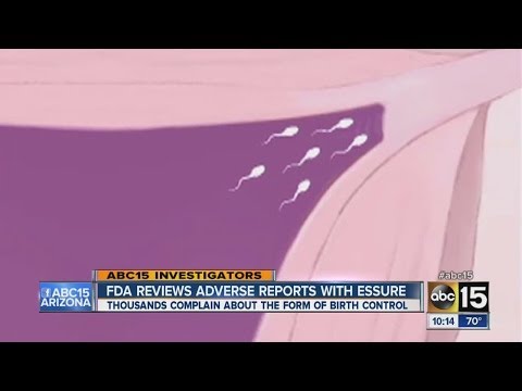 how to remove essure
