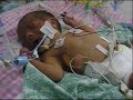 31 Week Preemie on Vent - 5 Days Old 31 Week Preemie on Vent - 5 Days Old