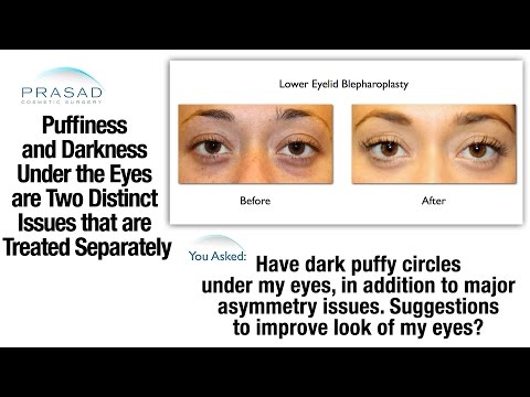 how to treat a bleed in the eye