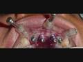 COMPUTER GUIDED DENTAL IMPLANTS INDIA PUNJAB JALANDHAR