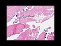 Histopathology Prostate--Adenocarcinoma Histopathology Prostate--Adenocarcinoma