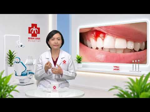CHẢY MÁU CHÂN RĂNG SAU KHI ĐÁNH RĂNG LÀ DẤU HIỆU...