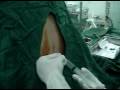 Epidural Anesthesia