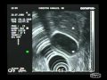 Gallbladder Polyps In Endoscopic Ultrasound Gallbladder Polyps In Endoscopic Ultrasound