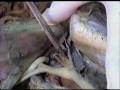 Common-Carotid-arter