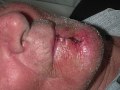 4 representative cases of squamous cell carcinoma of the lips are presented.
