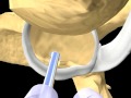 Click to View : Bankart - Patients Education