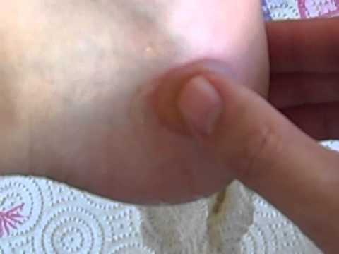 how to drain blister