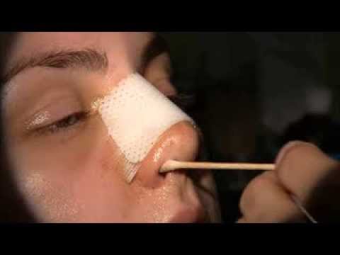 how to properly massage nose after rhinoplasty