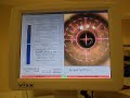 PRK Surface Ablation Eye Surgery PRK Surface Ablation Eye Surgery
