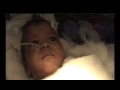 Doctors Separate Indian Conjoined Twins