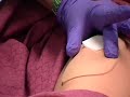 McLennan Community College (MCC) Intramuscular Injection McLennan Community College (MCC) Intramuscular Injection
