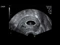 This a fantastic video showing the stages of baby growth from 5 to 9 weeks and also in 3d. It is annotated so can be used for learning by medical professionals. Please like the videos and subscribe to our channel we will have many more educational videos coming.