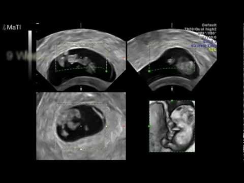 how to get more ultrasounds during pregnancy