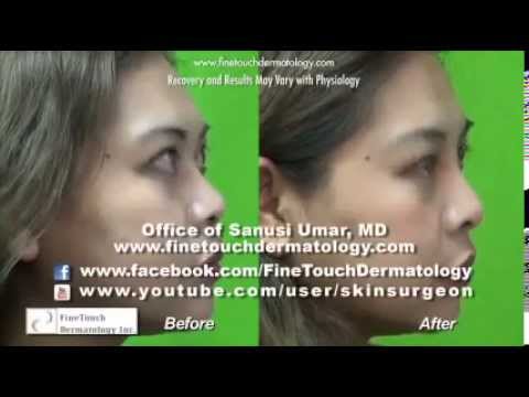 how to define nose naturally