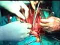 videos de Heart Transplant Unbelievable