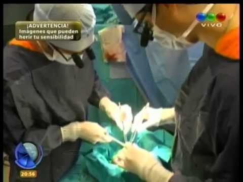 Operativo de trasplante de corazón Operativo de trasplante de corazón